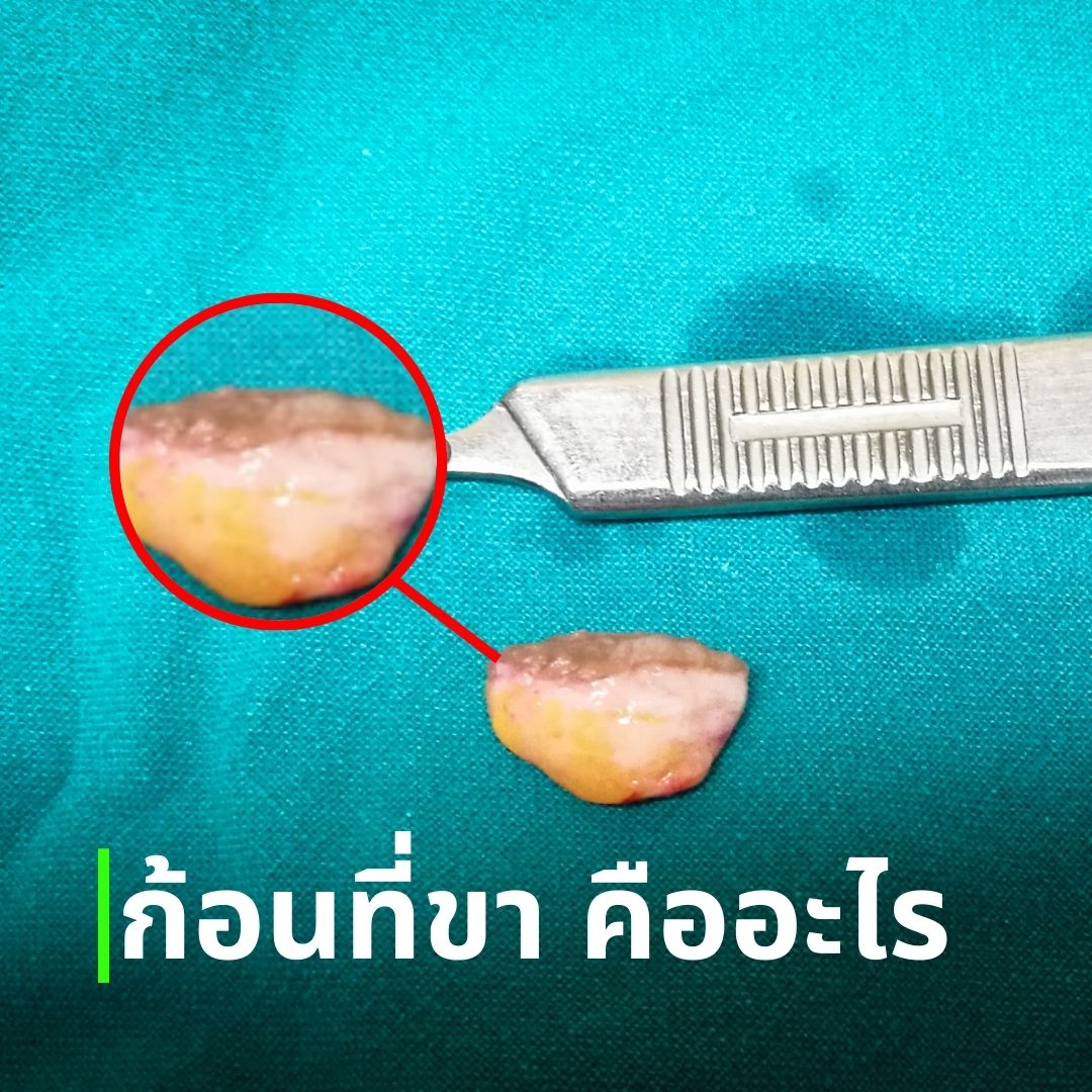 ก้อนที่ขา คืออะไร ดูให้เป็น