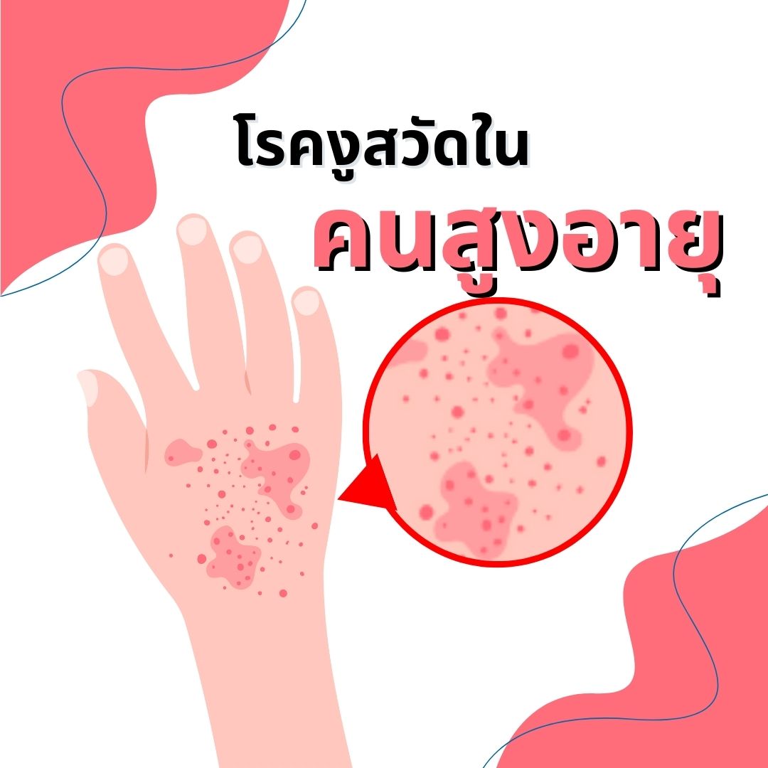 โรคงูสวัดในคนสูงอายุ: สาเหตุ วิธีป้องกัน และการรักษา
